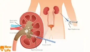 علاج حصى الكلى
