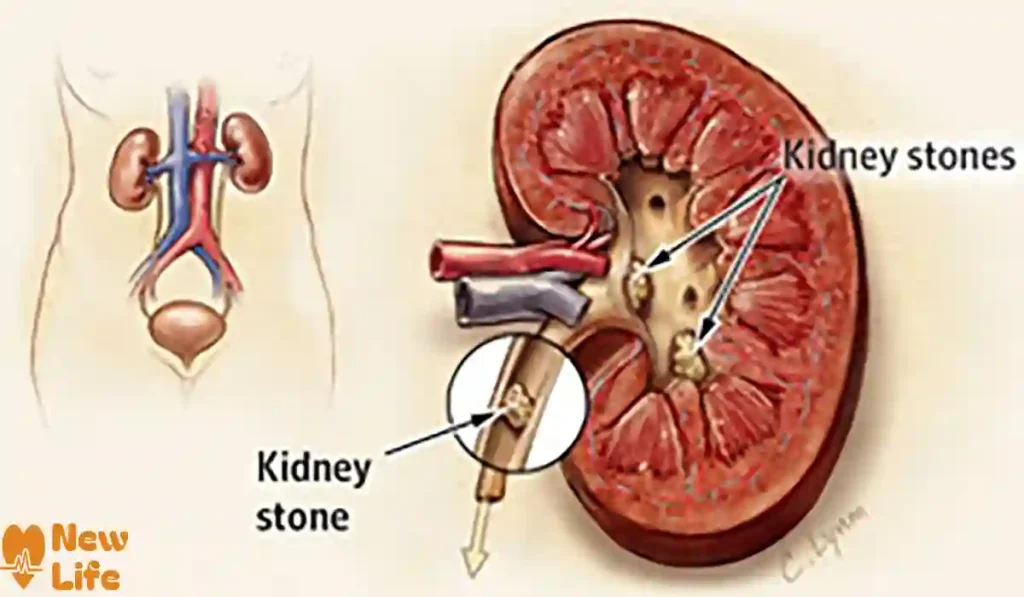 حصوة الكلى